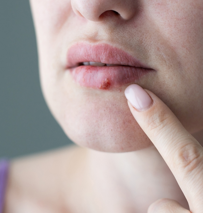 cold sore treatment