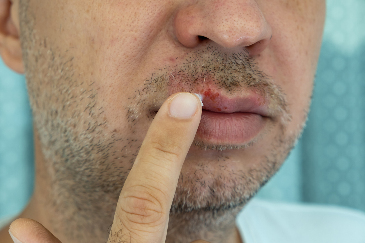 cold sore symptoms